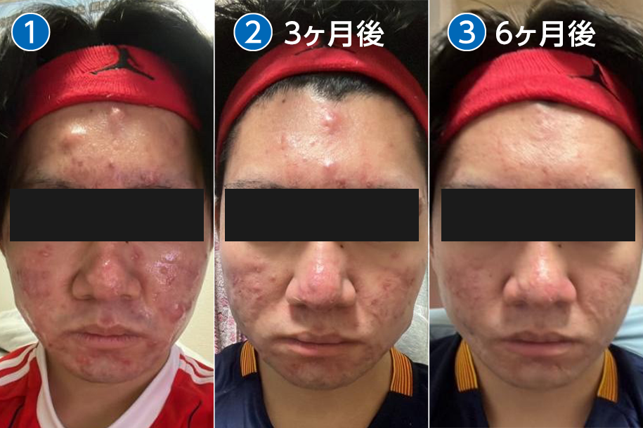 プラズマシャワー before・after