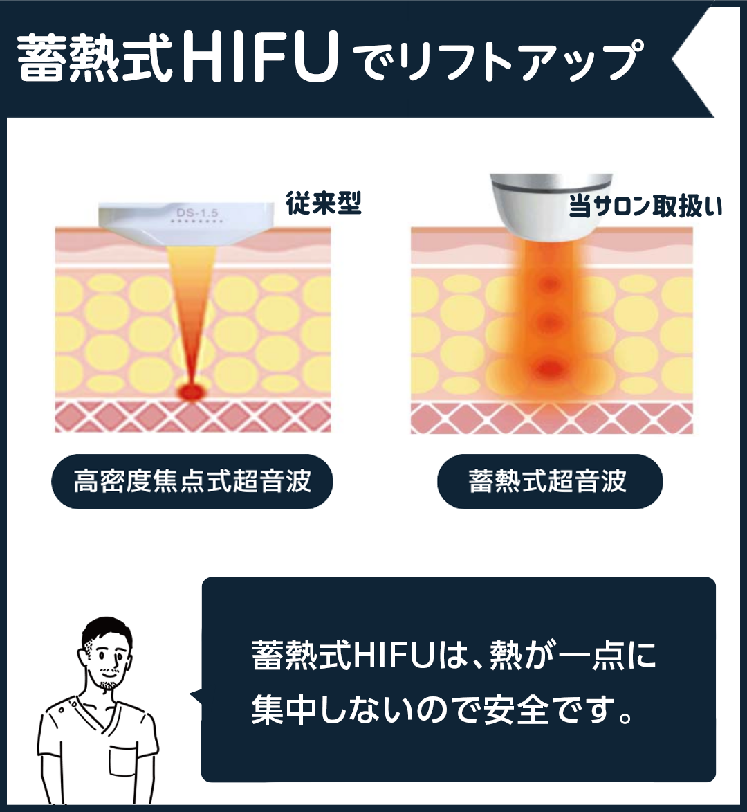蓄熱式HIFUって？